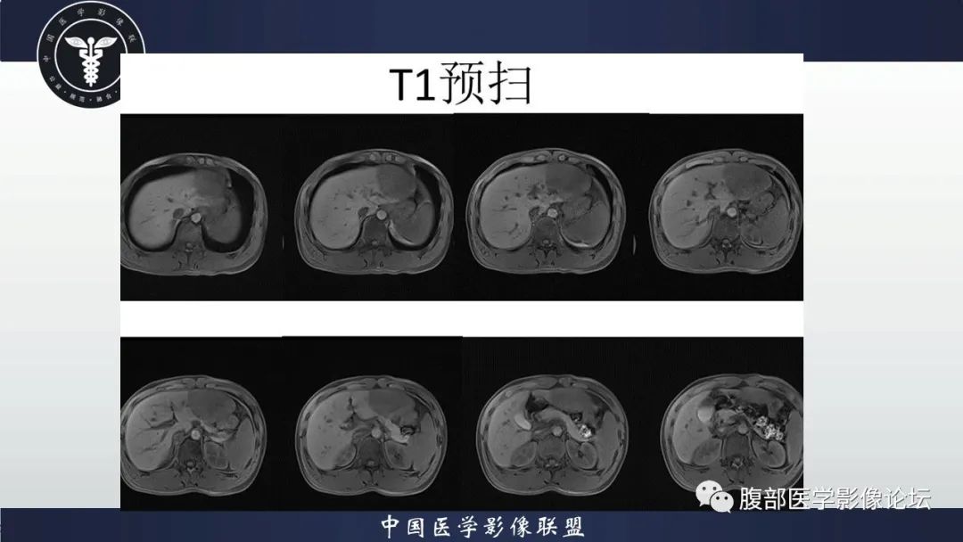 影像PPT - 【病例】肝脏肝细胞腺瘤1例MR影像-7