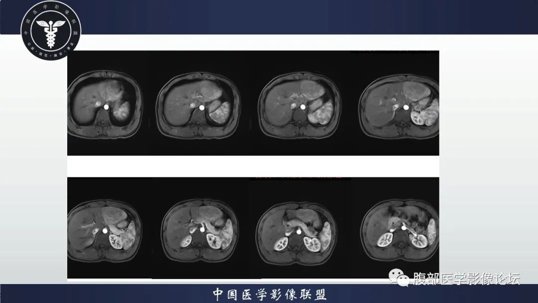 影像PPT - 【病例】肝脏肝细胞腺瘤1例MR影像-8