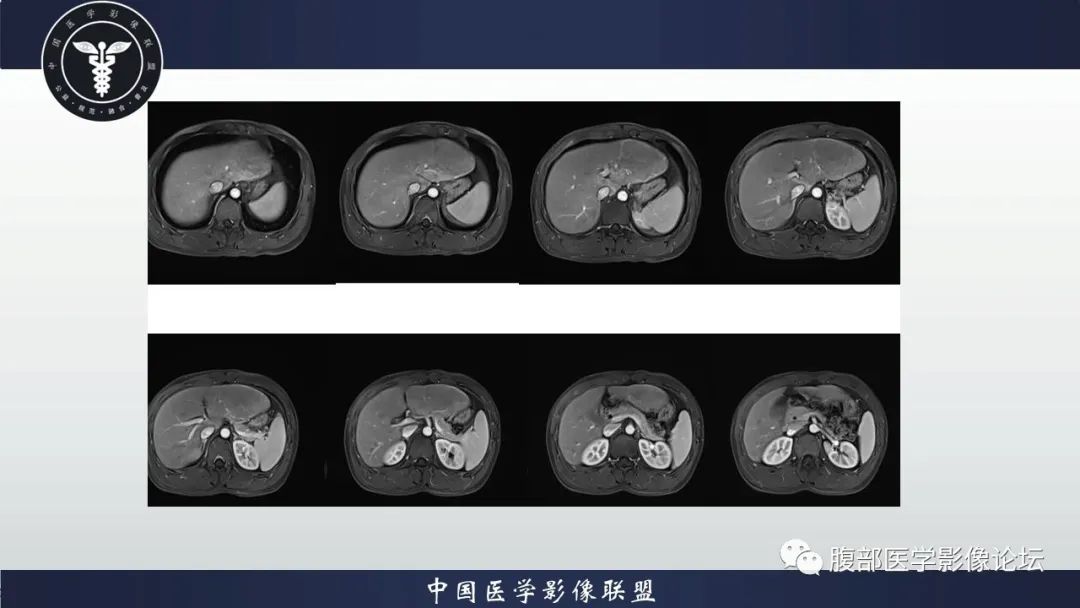 影像PPT - 【病例】肝脏肝细胞腺瘤1例MR影像-9
