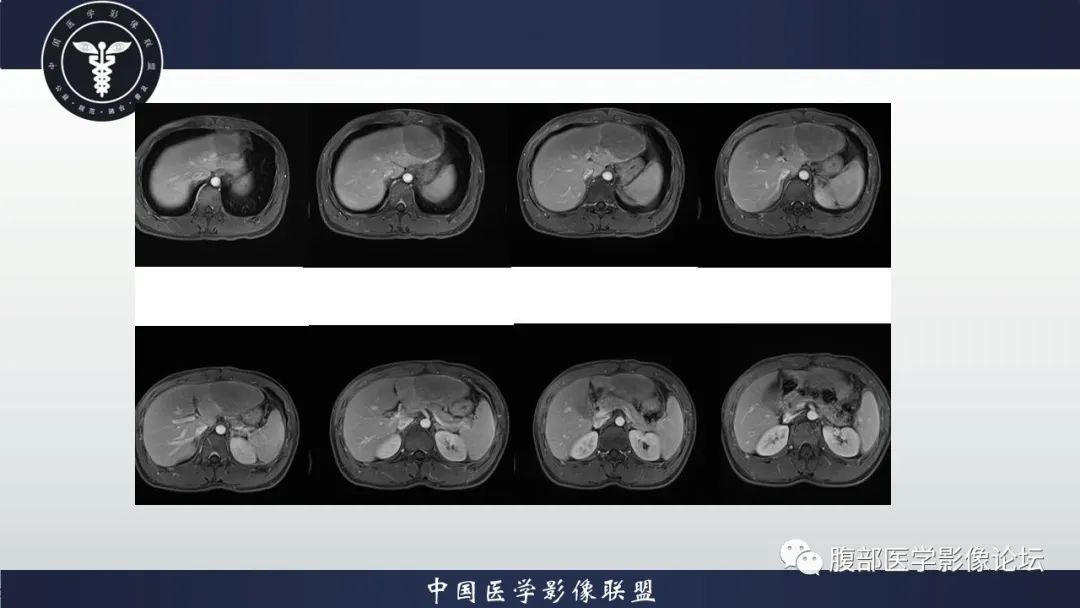 影像PPT - 【病例】肝脏肝细胞腺瘤1例MR影像-10
