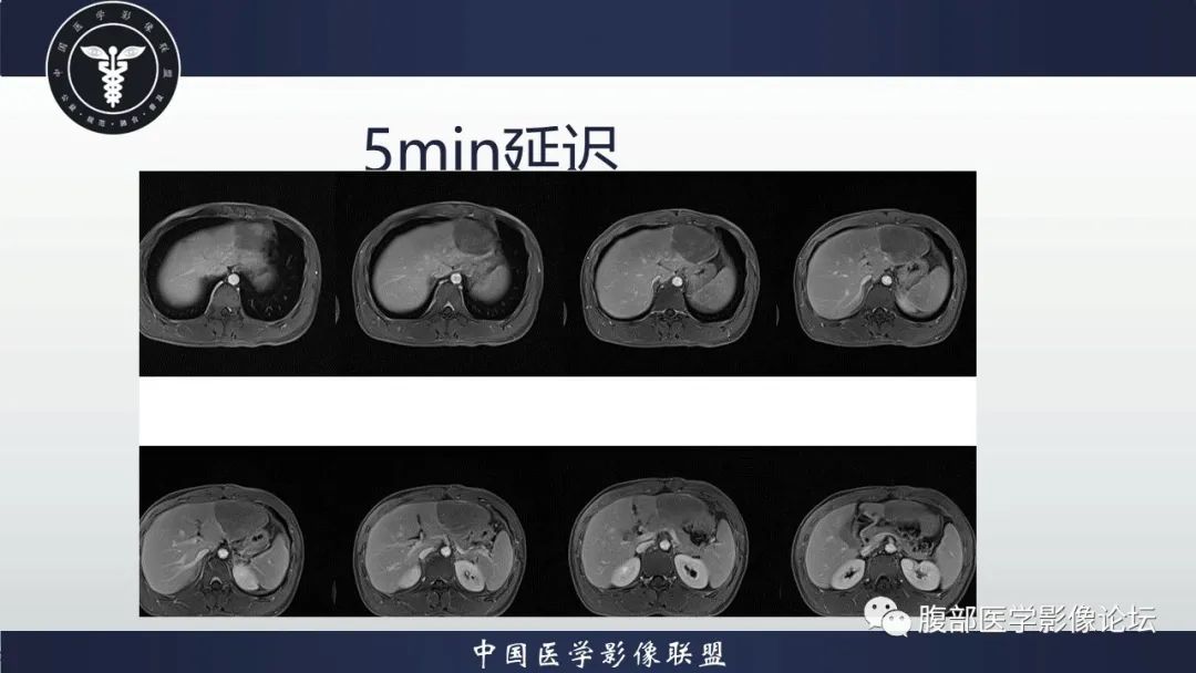 影像PPT - 【病例】肝脏肝细胞腺瘤1例MR影像-11