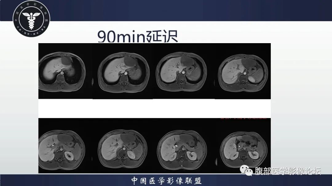 影像PPT - 【病例】肝脏肝细胞腺瘤1例MR影像-12