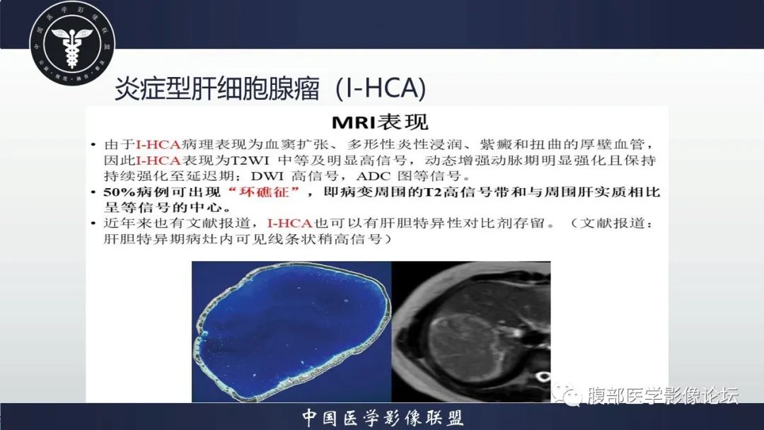 影像PPT - 【病例】肝脏肝细胞腺瘤1例MR影像-16