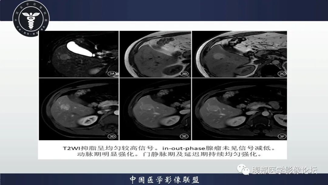 影像PPT - 【病例】肝脏肝细胞腺瘤1例MR影像-17