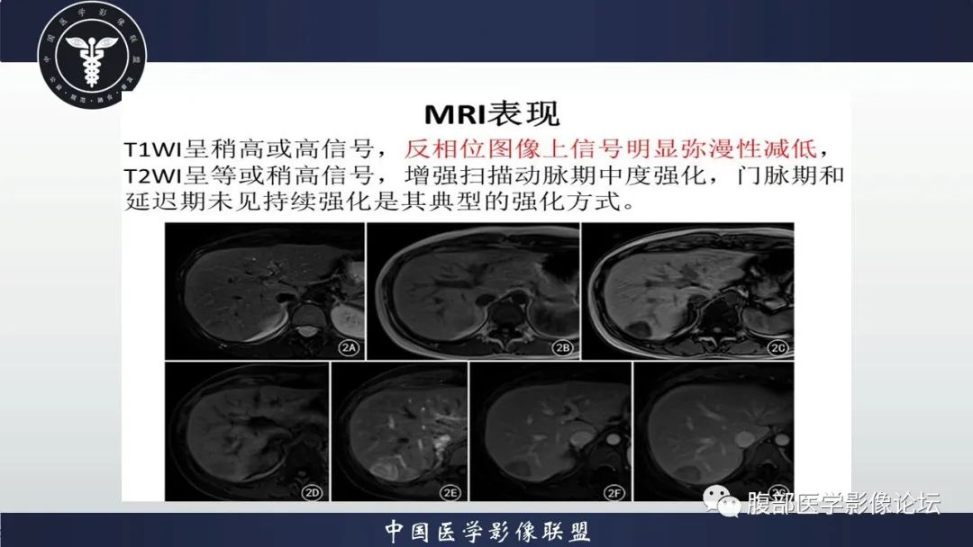 影像PPT - 【病例】肝脏肝细胞腺瘤1例MR影像-19