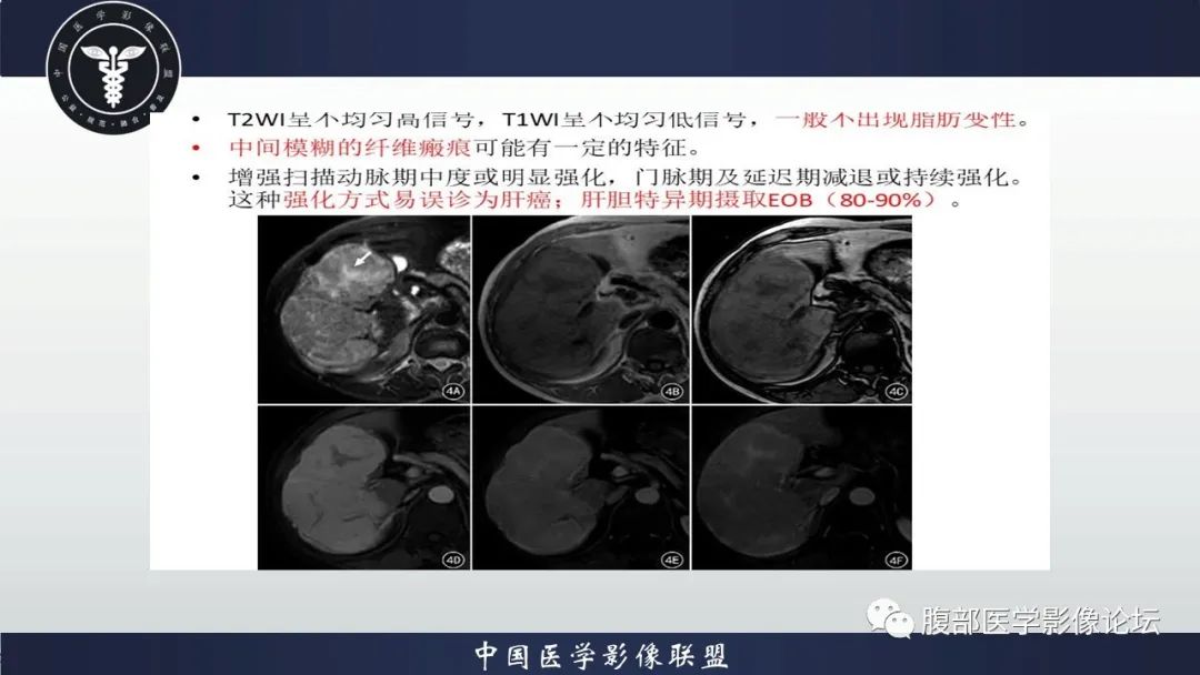 影像PPT - 【病例】肝脏肝细胞腺瘤1例MR影像-21