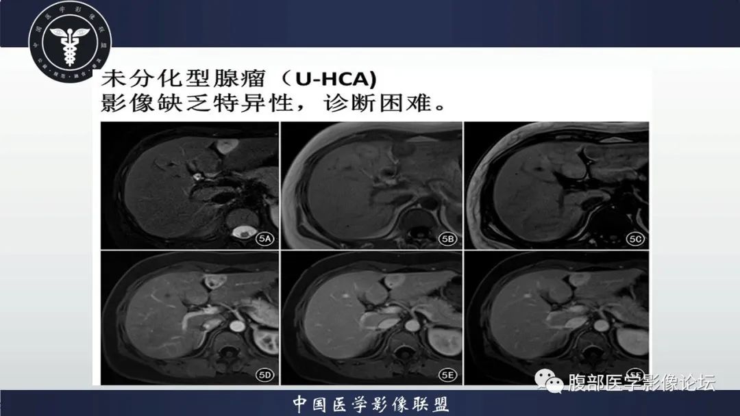 影像PPT - 【病例】肝脏肝细胞腺瘤1例MR影像-22