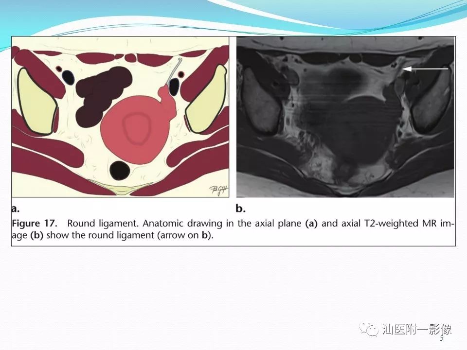 影像PPT - 【PPT】女性盆腔结构解剖复习-5
