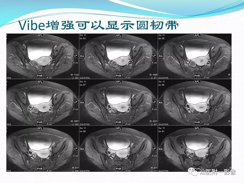 影像PPT - 【PPT】女性盆腔结构解剖复习-6