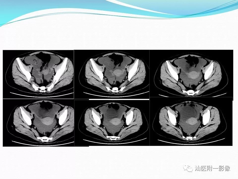 影像PPT - 【PPT】女性盆腔结构解剖复习-7