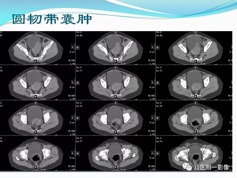 影像PPT - 【PPT】女性盆腔结构解剖复习-9