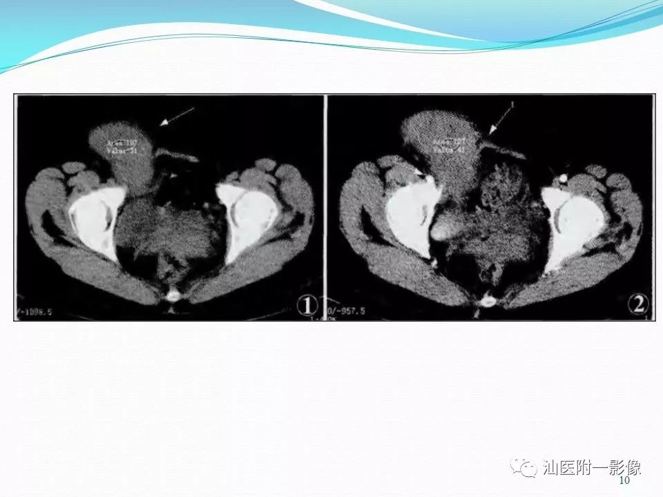 影像PPT - 【PPT】女性盆腔结构解剖复习-10