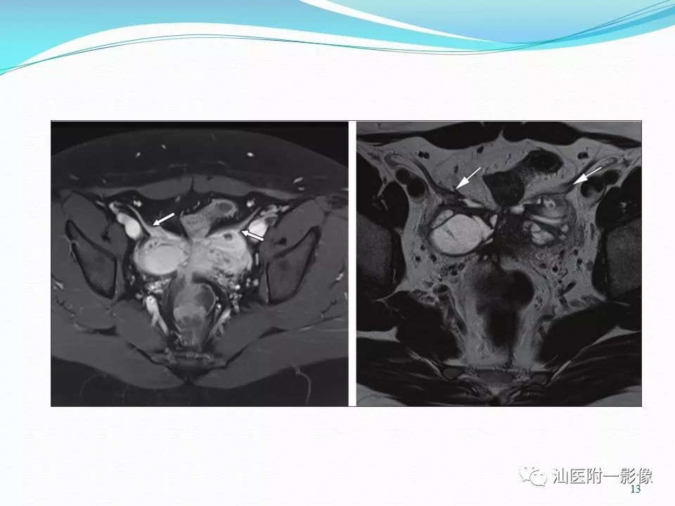 影像PPT - 【PPT】女性盆腔结构解剖复习-13