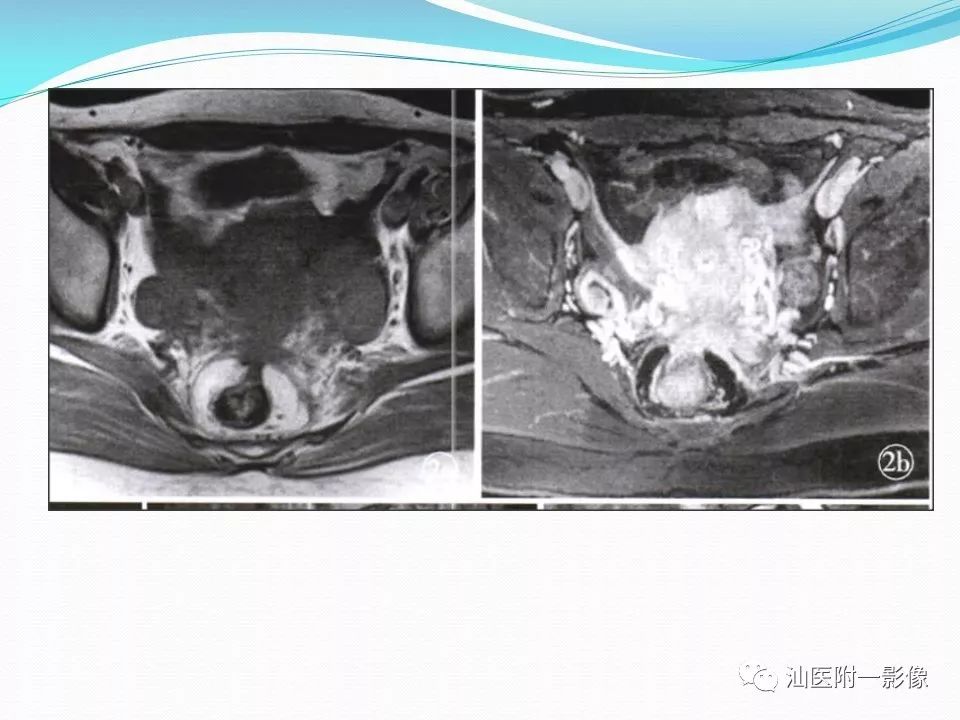 影像PPT - 【PPT】女性盆腔结构解剖复习-16