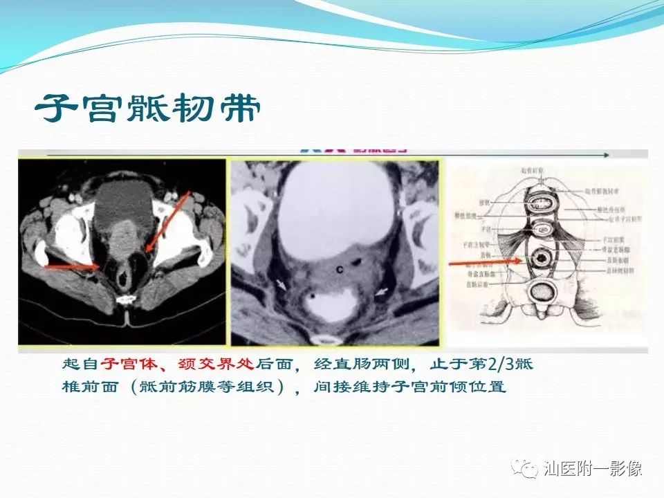 影像PPT - 【PPT】女性盆腔结构解剖复习-14