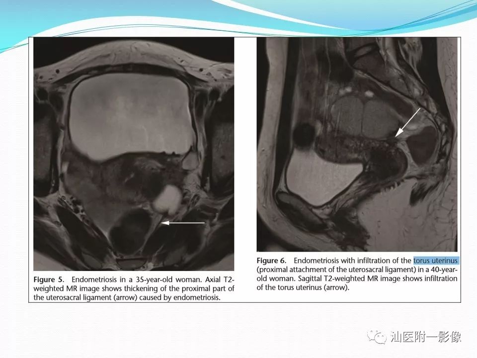 影像PPT - 【PPT】女性盆腔结构解剖复习-17