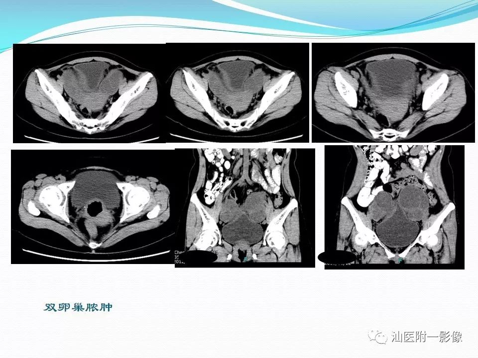 影像PPT - 【PPT】女性盆腔结构解剖复习-18