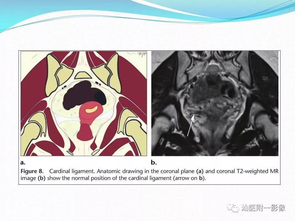 影像PPT - 【PPT】女性盆腔结构解剖复习-20