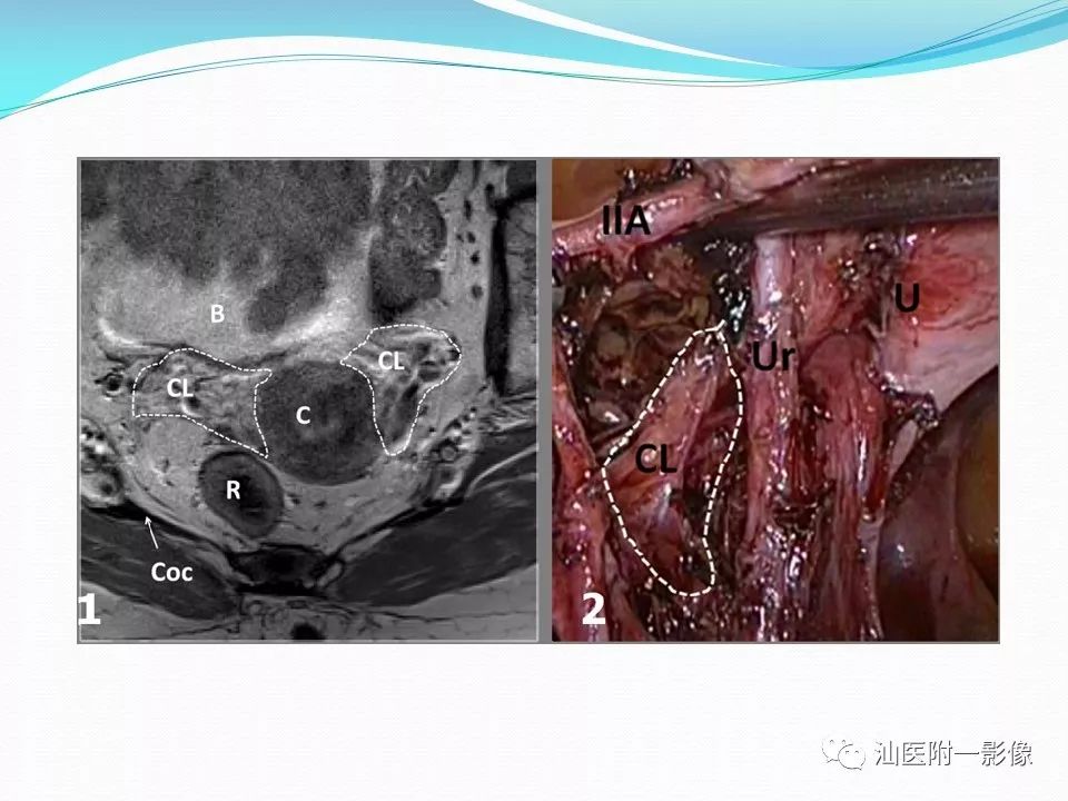 影像PPT - 【PPT】女性盆腔结构解剖复习-21