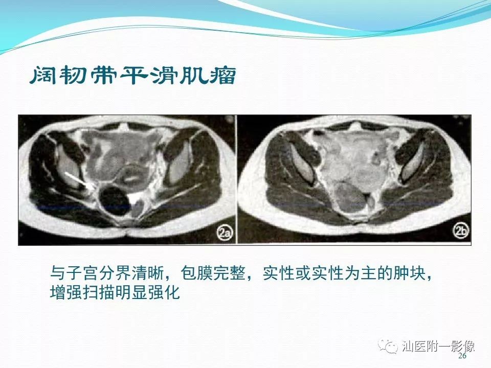 影像PPT - 【PPT】女性盆腔结构解剖复习-26