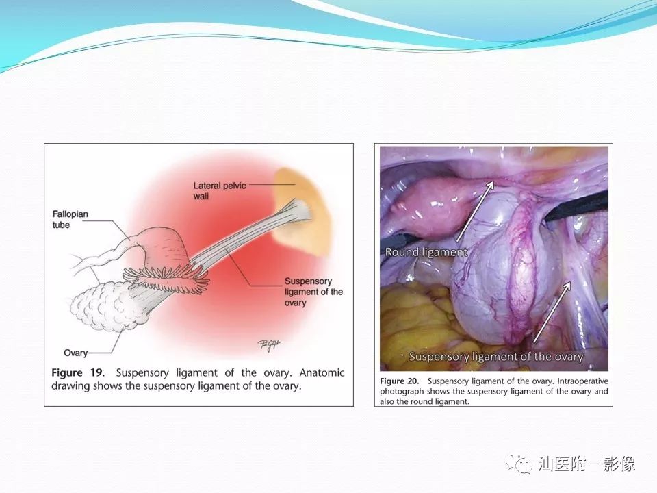 影像PPT - 【PPT】女性盆腔结构解剖复习-28