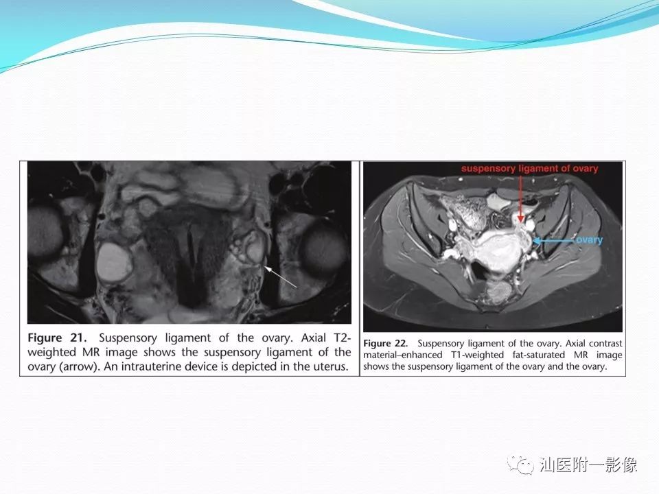 影像PPT - 【PPT】女性盆腔结构解剖复习-29