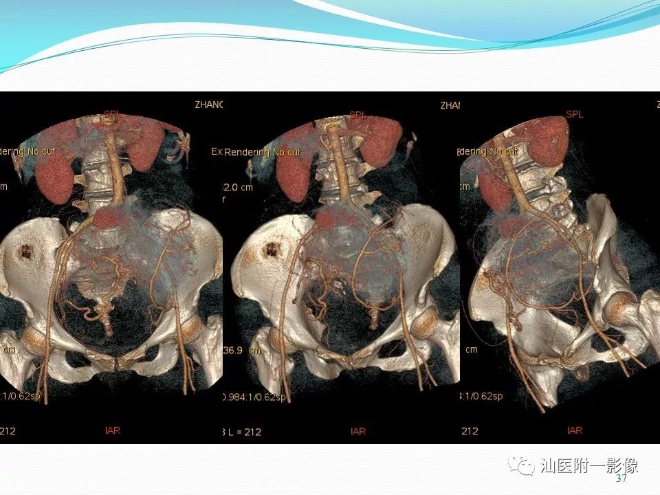 影像PPT - 【PPT】女性盆腔结构解剖复习-37
