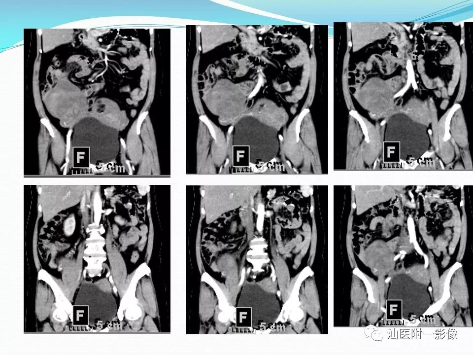 影像PPT - 【PPT】女性盆腔结构解剖复习-38