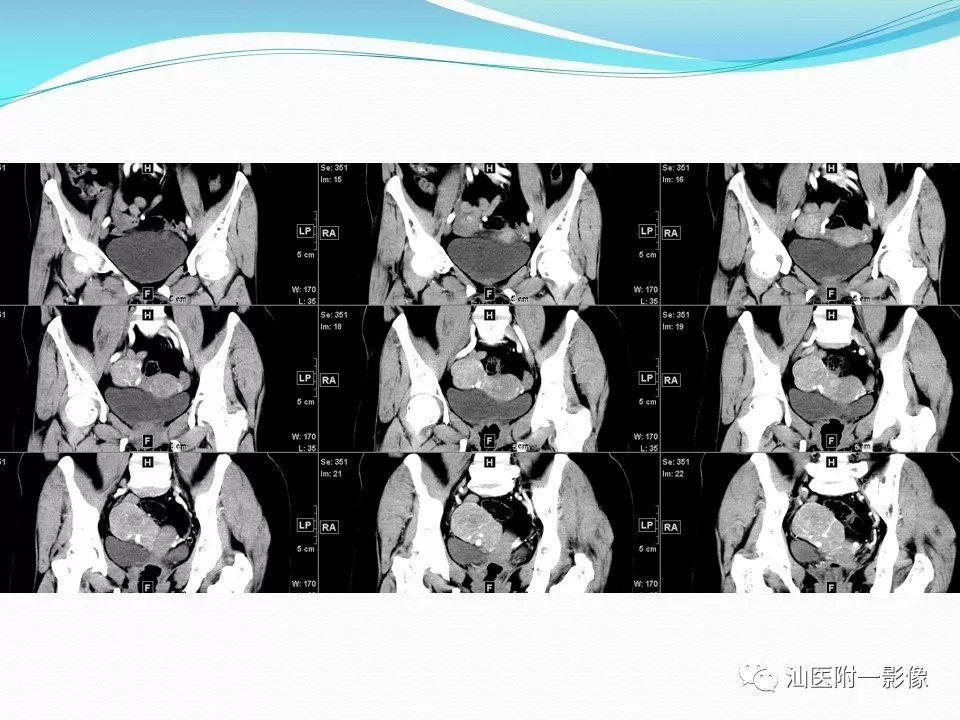 影像PPT - 【PPT】女性盆腔结构解剖复习-41