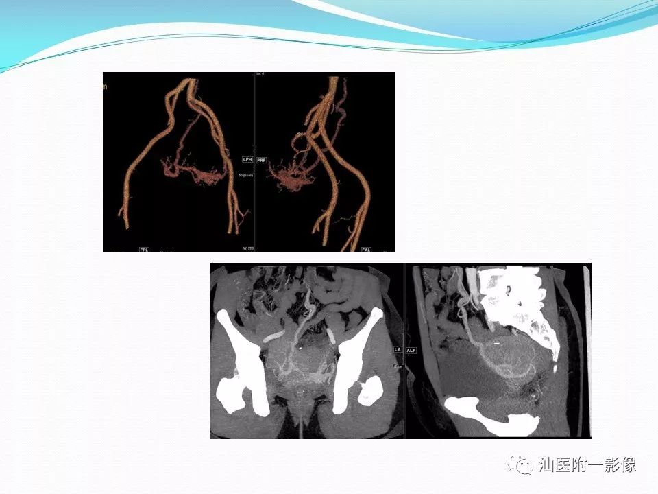 影像PPT - 【PPT】女性盆腔结构解剖复习-43