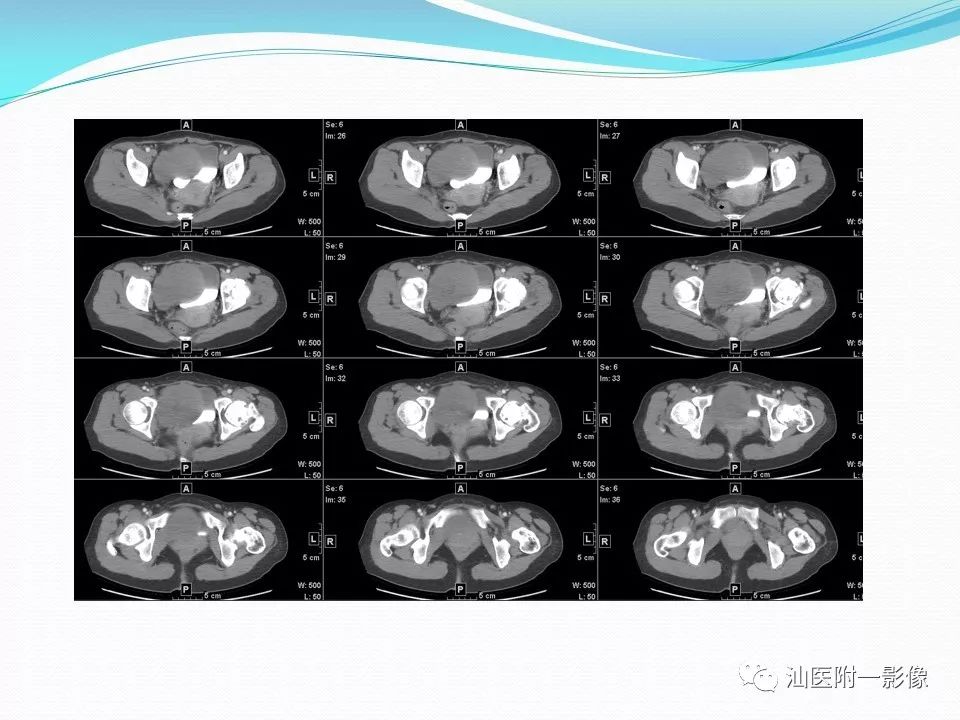 影像PPT - 【PPT】女性盆腔结构解剖复习-47