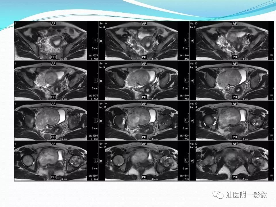 影像PPT - 【PPT】女性盆腔结构解剖复习-48
