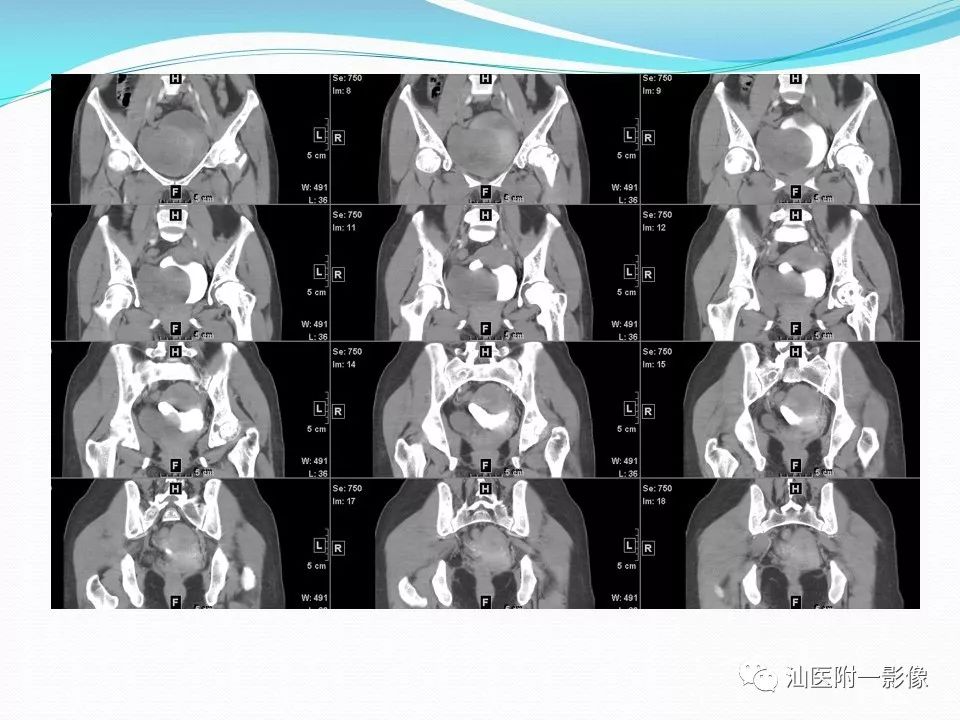 影像PPT - 【PPT】女性盆腔结构解剖复习-49