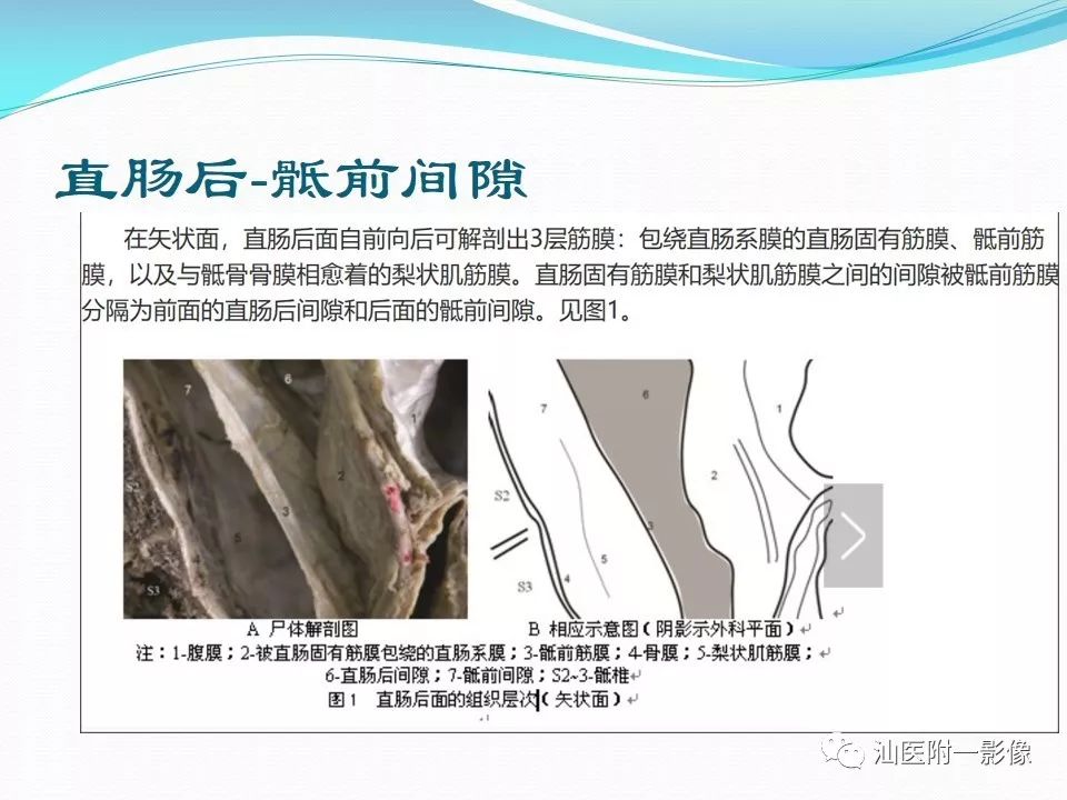 影像PPT - 【PPT】女性盆腔结构解剖复习-50