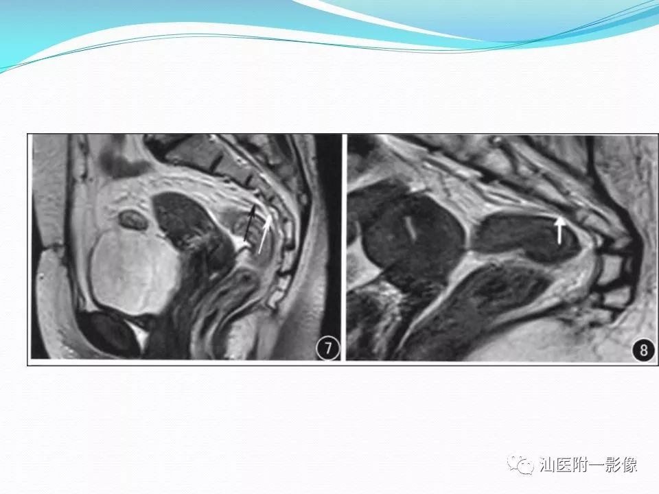 影像PPT - 【PPT】女性盆腔结构解剖复习-52