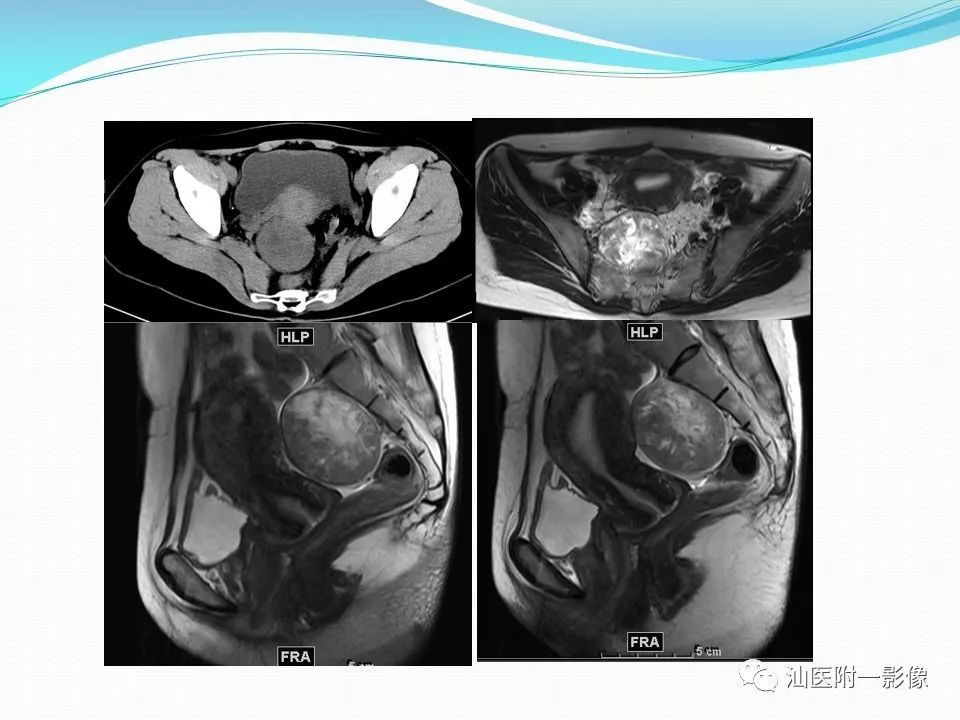 影像PPT - 【PPT】女性盆腔结构解剖复习-53