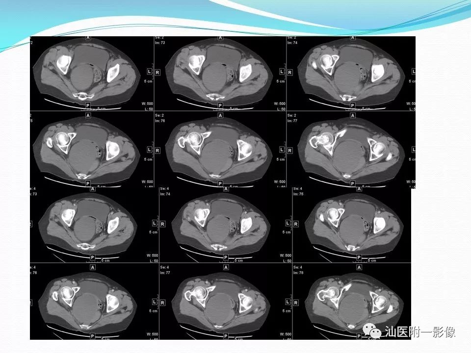 影像PPT - 【PPT】女性盆腔结构解剖复习-54