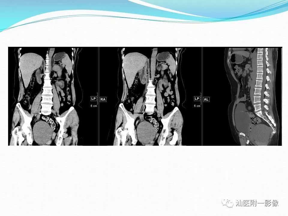 影像PPT - 【PPT】女性盆腔结构解剖复习-55