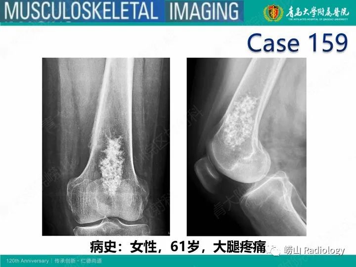 影像PPT - 【PPT】软骨肉瘤-2