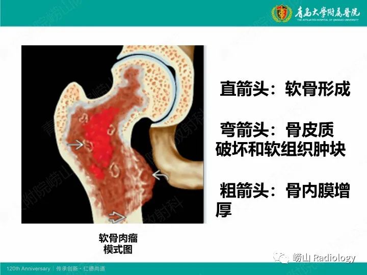 影像PPT - 【PPT】软骨肉瘤-21