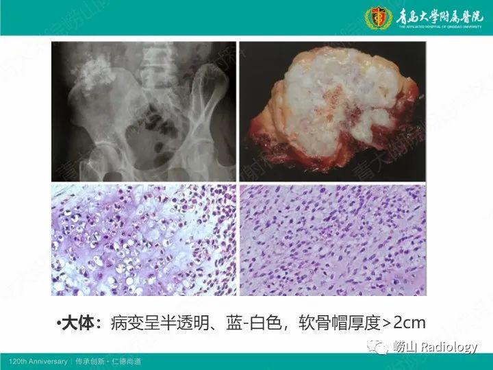 影像PPT - 【PPT】软骨肉瘤-23