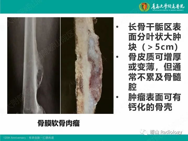 影像PPT - 【PPT】软骨肉瘤-25