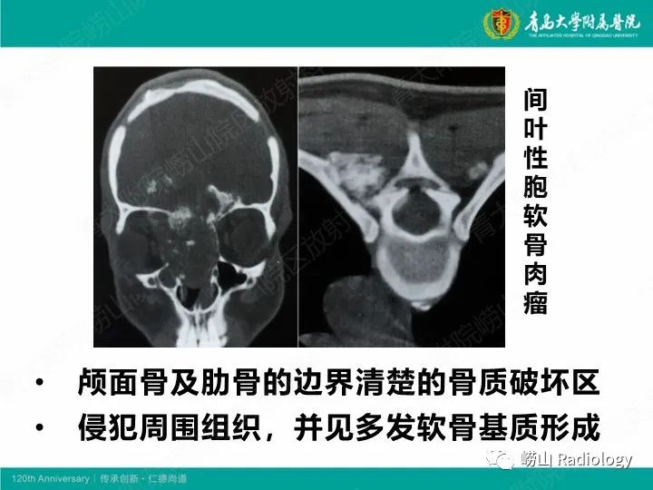 影像PPT - 【PPT】软骨肉瘤-29