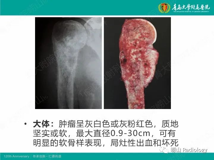 影像PPT - 【PPT】软骨肉瘤-30