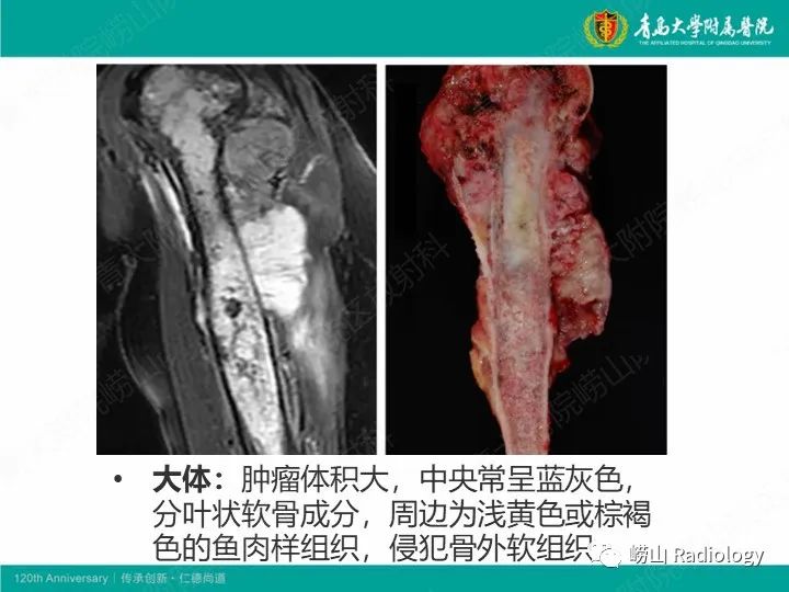 影像PPT - 【PPT】软骨肉瘤-32