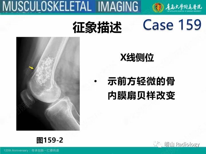 影像PPT - 【PPT】软骨肉瘤-34