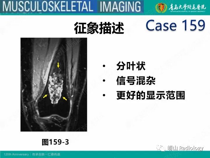 影像PPT - 【PPT】软骨肉瘤-35
