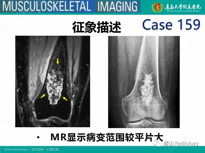 影像PPT - 【PPT】软骨肉瘤-36