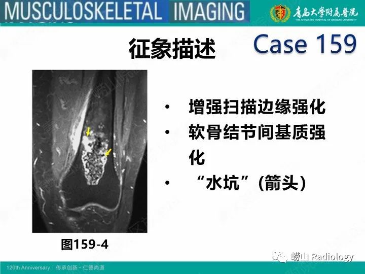 影像PPT - 【PPT】软骨肉瘤-37