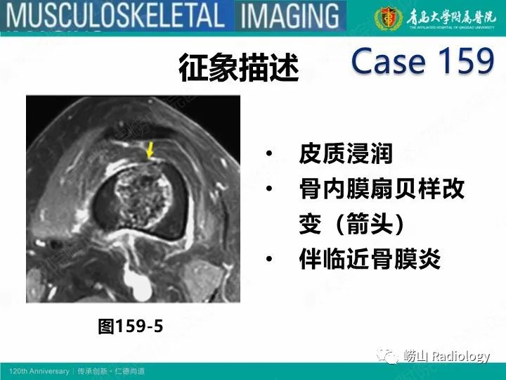 影像PPT - 【PPT】软骨肉瘤-38